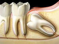 Удаление зубов в Имплант-Центре