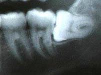 Удаление зубов в стоматологии Имплант-Центр